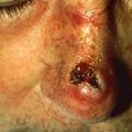 skin–tumour.jpg