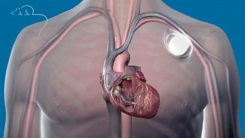 Pacemakers: then, now and next?