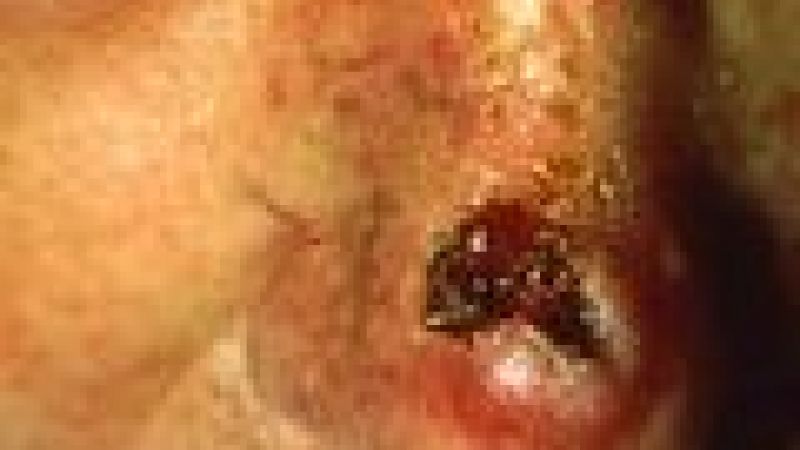 Skin tumour reduced in mice