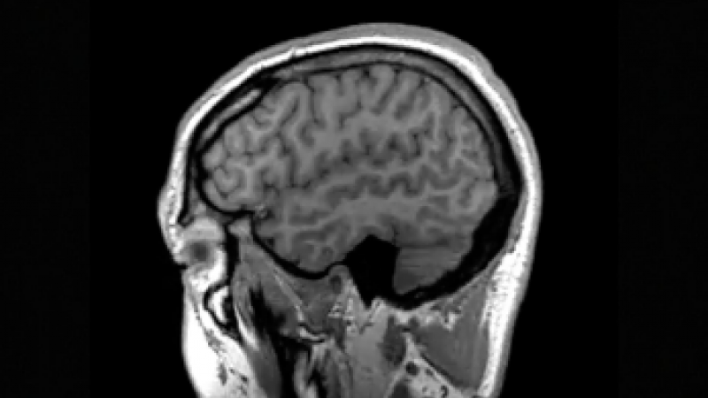 Is your MRI scan accurate?