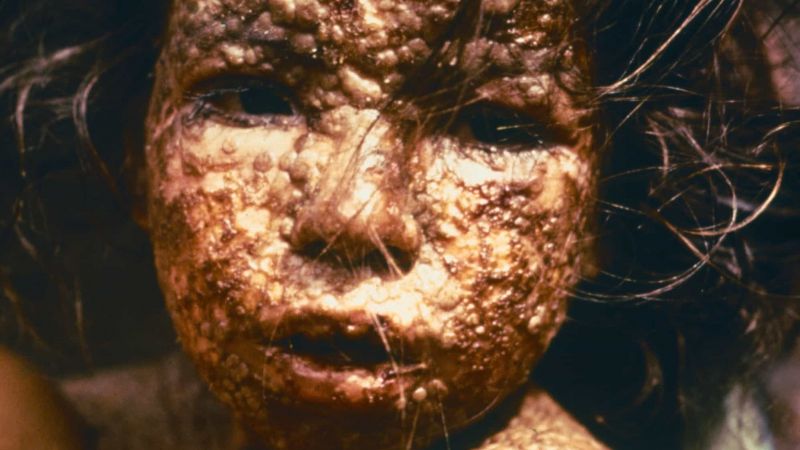 Smallpox