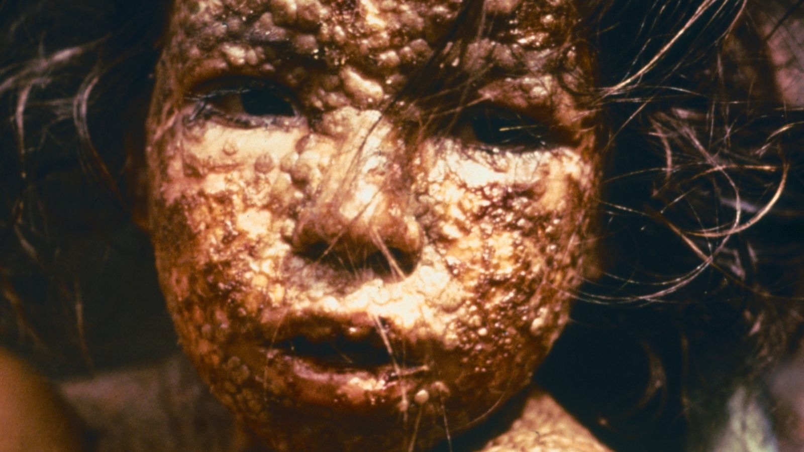 #WW Wednesday Web award - Smallpox Through Time