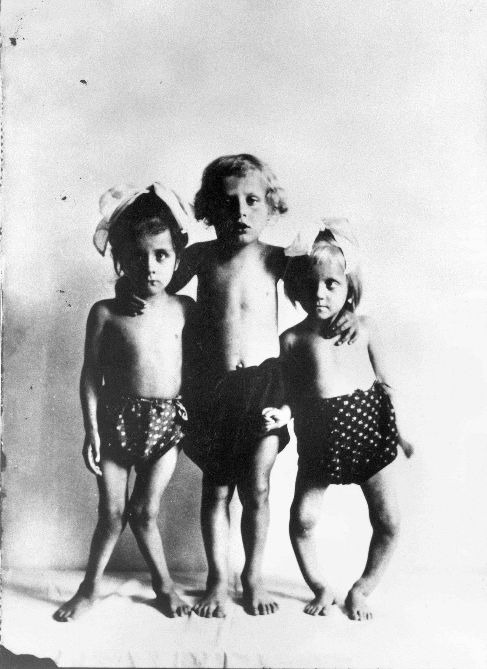 Three children with rickets